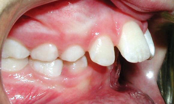 Protrusion Janzen & Chwa Orthodontics in Northbrook, IL