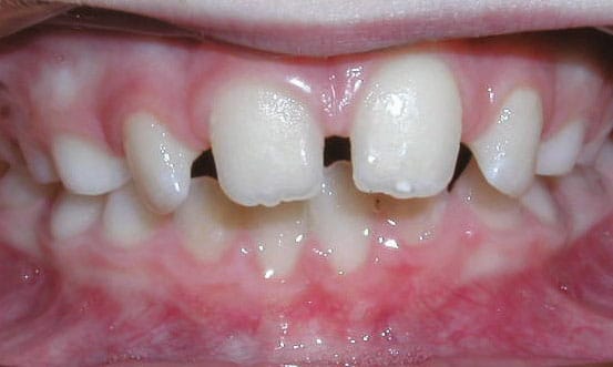 Spacing Janzen & Chwa Orthodontics in Northbrook, IL