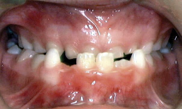 Underbite Janzen & Chwa Orthodontics in Northbrook, IL